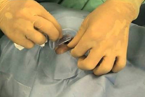 Aashirwad Agencies, Surgical Equipment & Instrument Supplier, Nashik Caesar Drape Disposable 